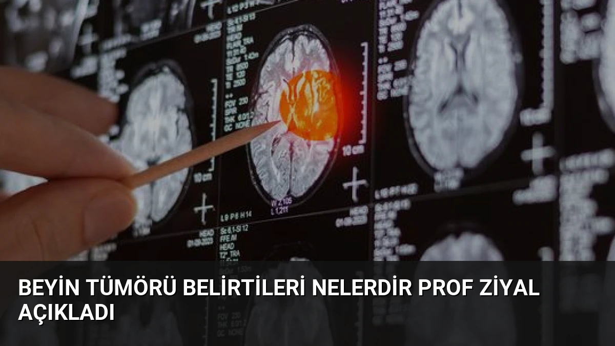 Beyin Tümörü Belirtileri Nelerdir Prof Ziyal Açıkladı