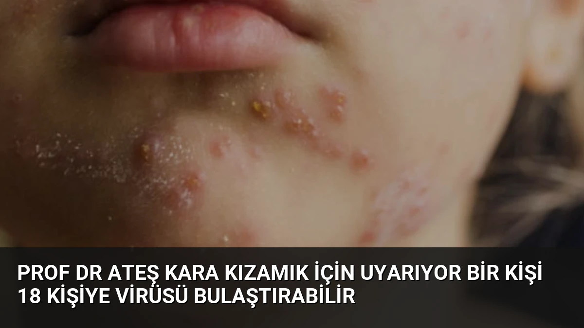 Prof Dr Ateş Kara Kızamık İçin Uyarıyor Bir Kişi 18 Kişiye Virüsü Bulaştırabilir