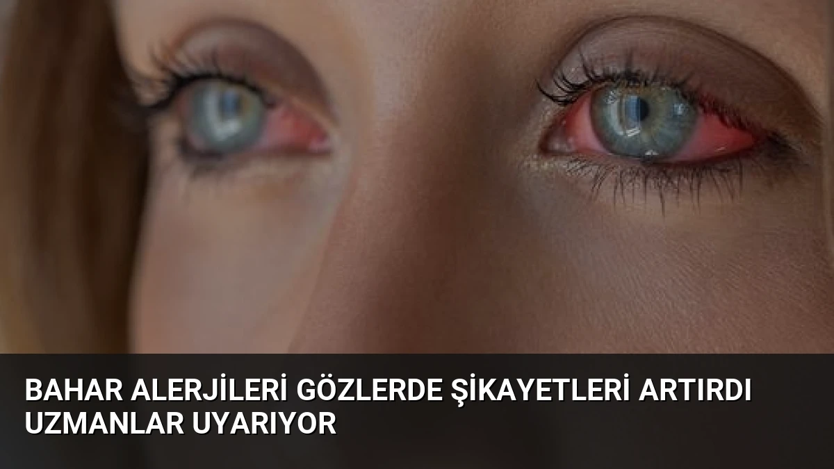 Bahar Alerjileri Gözlerde Şikayetleri Artırdı Uzmanlar Uyarıyor