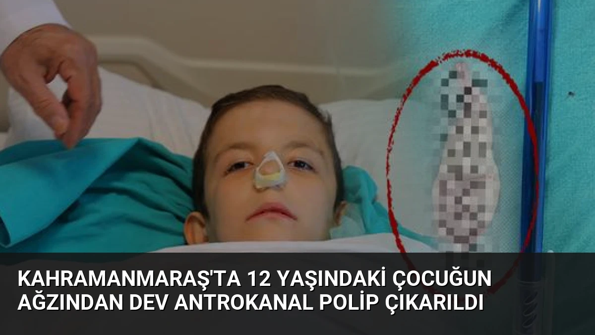 Kahramanmaraş’ta 12 Yaşındaki Çocuğun Ağzından Dev Antrokanal Polip Çıkarıldı